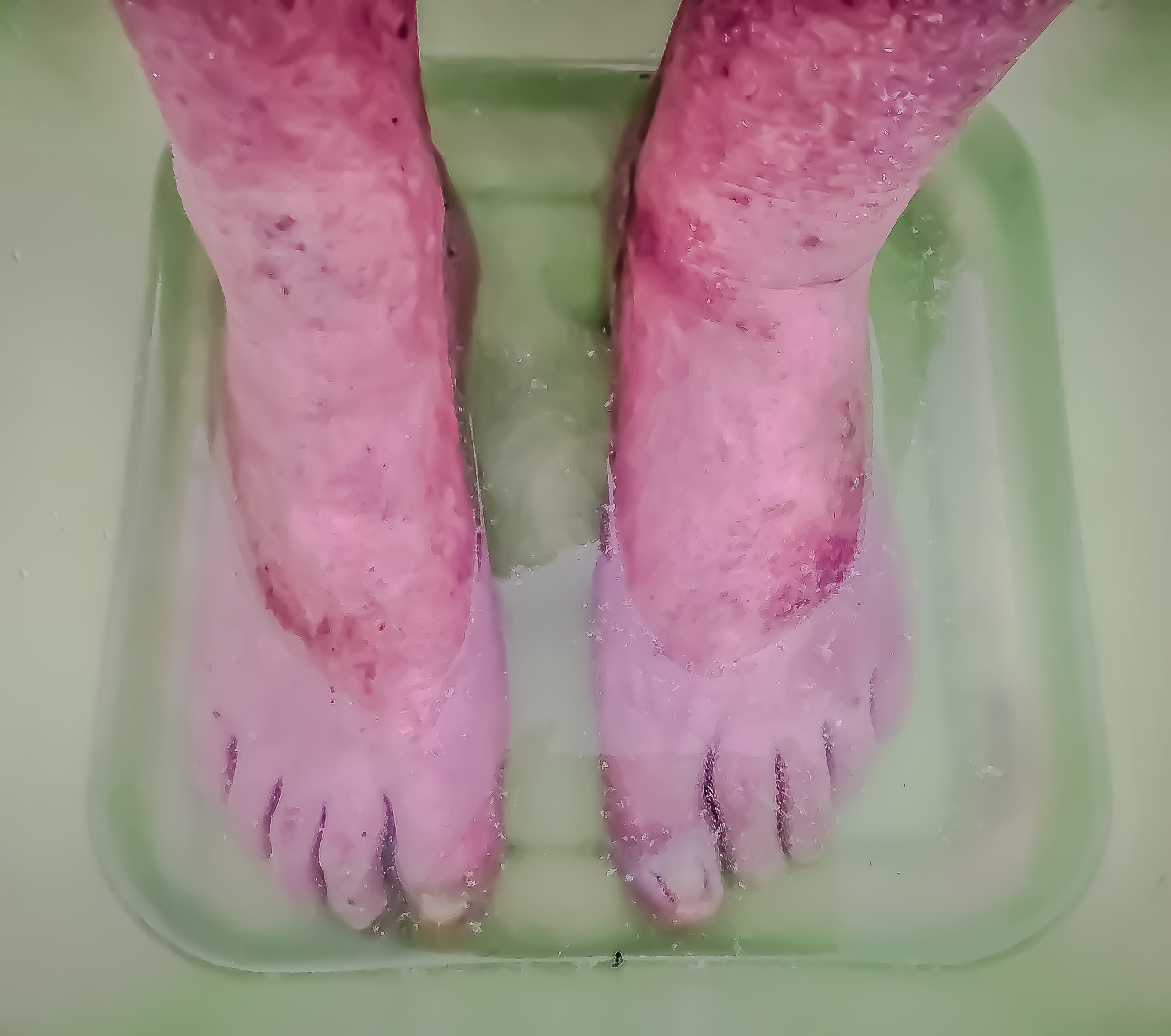 Peripheral Vascular Disease
